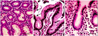 Serum Cytokine Signature That Discriminates Helicobacter pylori Positive and Negative Juvenile Gastroduodenitis